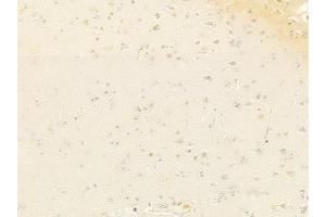 ABIN6261830 and ABIN6278360 at 1/100 staining human glioblastoma by IHC-P. (TLS/FUS (C-Term) 抗体)