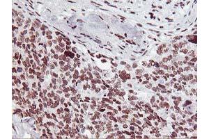 Immunohistochemical staining of paraffin-embedded Adenocarcinoma of Human breast tissue using anti-HOXC11 mouse monoclonal antibody. (HOXC11 抗体  (AA 1-304))