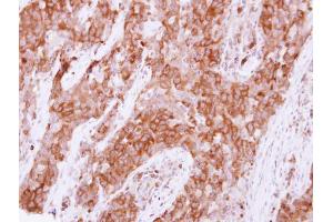 IHC-P Image Immunohistochemical analysis of paraffin-embedded human lung papillory adenocarcinoma, using Pez, antibody at 1:500 dilution. (PTPN14 抗体  (C-Term))