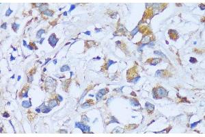 Immunohistochemistry of paraffin-embedded Human breast cancer using ACADSB Polyclonal Antibody at dilution of 1:100 (40x lens). (ACADSB 抗体)