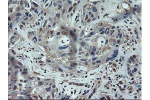 Immunohistochemical staining of paraffin-embedded Carcinoma of liver using anti-APOM (ABIN2452530) mouse monoclonal antibody. (Apolipoprotein M 抗体  (AA 23-188))