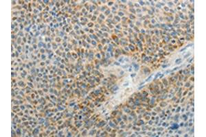 The image on the left is immunohistochemistry of paraffin-embedded Human liver cancer tissue using ABIN7189711(AGAP1 Antibody) at dilution 1/25, on the right is treated with synthetic peptide. (AGAP1 抗体)