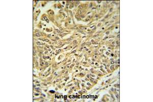 GSTK1 Antibody IHC analysis in formalin fixed and paraffin embedded lung carcinoma followed by peroxidase conjugation of the secondary antibody and DAB staining. (GSTK1 抗体  (AA 93-120))