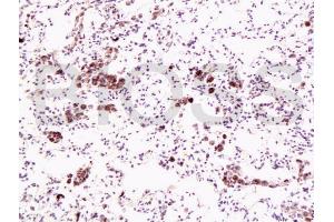 Formalin-fixed and paraffin embedded human lung carcinoma labeled with Anti-Dnmt1 Polyclonal Antibody, Unconjugated (ABIN671796) at 1:200, followed by conjugation to the secondary antibody and DAB staining (DNMT1 抗体  (AA 21-120))