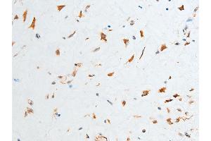 ABIN6267250 at 1/100 staining human glioma tissue sections by IHC-P. (CHEK2 抗体  (pThr387))