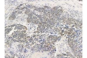 ABIN6259055 and ABIN6275393 at 1/100 staining human large cell lung carcinoma by IHC-P. (PRPF18 抗体  (Internal Region))