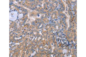 Immunohistochemistry of Human thyroid cancer using SIGLEC7 Polyclonal Antibody at dilution of 1:50 (SIGLEC7 抗体)