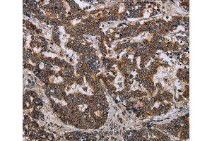Immunohistochemistry of Human ovarian cancer using LGALS2 Polyclonal Antibody at dilution of 1:30 (Galectin 2 抗体)