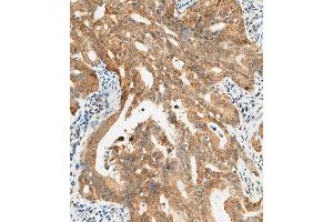 (ABIN657450 and ABIN2846476) staining CTAG1A in human gastric carcinoma tissue sections by Immunohistochemistry (IHC-P - paraformaldehyde-fixed, paraffin-embedded sections). (CTAG1A 抗体  (N-Term))