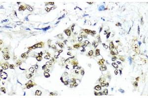 Immunohistochemistry of paraffin-embedded Human lung cancer using SUMO1 Polyclonal Antibody at dilution of 1:200 (40x lens). (SUMO1 抗体)