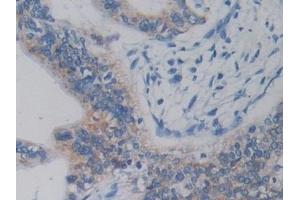 Detection of DCLK1 in Human Prostate Tissue using Polyclonal Antibody to Doublecortin Like Kinase 1 (DCLK1) (DCLK1 抗体  (AA 390-647))