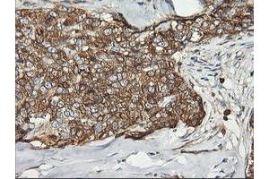 Immunohistochemical staining of paraffin-embedded Adenocarcinoma of Human breast tissue using anti-PFKP mouse monoclonal antibody. (PFKP 抗体)