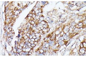 Immunohistochemistry of paraffin-embedded Human colon carcinoma using NUBP1 Polyclonal Antibody at dilution of 1:100 (40x lens). (NUBP1 抗体)