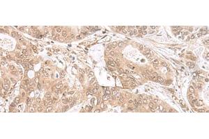 Immunohistochemistry of paraffin-embedded Human gastric cancer tissue using ETV3 Polyclonal Antibody at dilution of 1:25(x200) (ETV3 抗体)