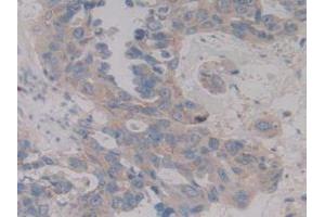 IHC-P analysis of Human Breast Cancer Tissue, with DAB staining. (MAP2K6 抗体  (AA 46-306))