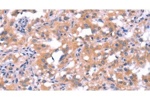 Immunohistochemistry of paraffin-embedded Human thyroid cancer tissue using FAT1 Polyclonal Antibody at dilution 1:40 (FAT1 抗体)