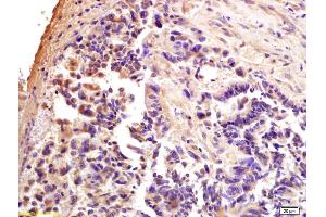 Formalin-fixed and paraffin embedded human rectal carcinoma labeled with Anti-CTCF Polyclonal Antibody, Unconjugated (ABIN703976) at 1:200 followed by conjugation to the secondary antibody and DAB staining. (CTCF 抗体  (AA 451-550))