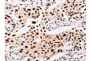The image on the left is immunohistochemistry of paraffin-embedded Human lung cancer tissue using ABIN7128323(AKAP8L Antibody) at dilution 1/20, on the right is treated with fusion protein. (AKAP8L 抗体)