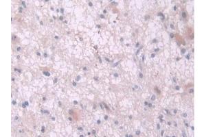 Detection of IL2 in Human Glioma Tissue using Polyclonal Antibody to Interleukin 2 (IL2) (IL-2 抗体  (AA 21-153))