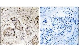 Immunohistochemistry analysis of paraffin-embedded human breast carcinoma tissue, using RCC2 Antibody. (RCC2 抗体  (AA 473-522))