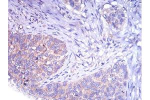 Immunohistochemical analysis of paraffin-embedded cervical cancer tissues using TH mouse mAb with DAB staining. (TH 抗体  (AA 44-208))