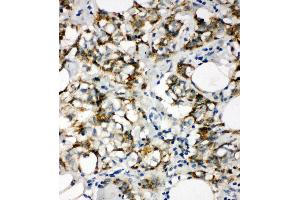 Anti-Cytokeratin 8 antibody, IHC(P) IHC(P): Human Mammary Cancer Tissue