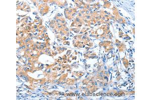 Immunohistochemistry of Human lung cancer using AUP1 Polyclonal Antibody at dilution of 1:50 (Ancient Ubiquitous Protein 1 抗体)