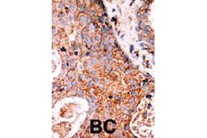 Formalin-fixed and paraffin-embedded human cancer tissue reacted with LMTK2 polyclonal antibody  , which was peroxidase-conjugated to the secondary antibody, followed by DAB staining. (LMTK2 抗体  (N-Term))
