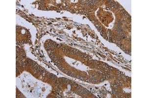 Immunohistochemistry of Human colon cancer using KLRF1 Polyclonal Antibody at dilution of 1:30 (KLRF1 抗体)