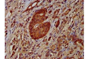 IHC image of ABIN7161669 diluted at 1:100 and staining in paraffin-embedded human pancreatic cancer performed on a Leica BondTM system. (NOMO1 抗体  (AA 918-1044))