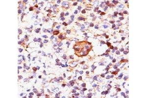 IHC testing of Hodgkin's lymphoma stained with Bax antibody (Clone 2D2). (BAX 抗体)