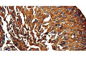 Immunohistochemistry of paraffin-embedded Human lung cancer using PKM Polyclonal Antibody at dilution of 1:50 (PKM 抗体)