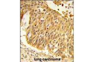 Formalin-fixed and paraffin-embedded human lung carcinoma reacted with EEFSEC Antibody , which was peroxidase-conjugated to the secondary antibody, followed by DAB staining. (EEFSEC 抗体  (C-Term))