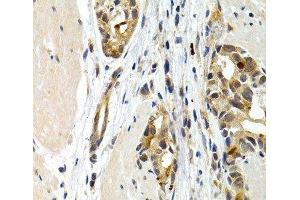Immunohistochemistry of paraffin-embedded Human stomach cancer using IL9 Polyclonal Antibody at dilution of 1:200 (40x lens). (IL-9 抗体)