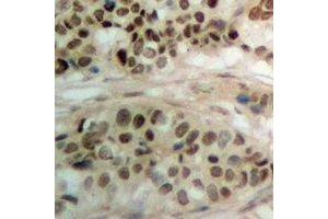 Immunohistochemical analysis of PBOV1 staining in human prostate cancer formalin fixed paraffin embedded tissue section. (PBOV1 抗体)