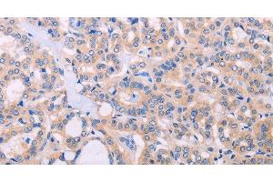 Immunohistochemistry of paraffin-embedded Human thyroid cancer tissue using ADCY5 Polyclonal Antibody at dilution 1:30 (ADCY5 抗体)
