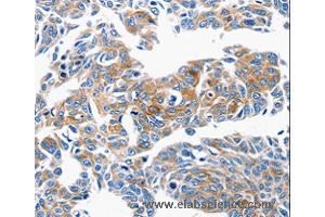 Immunohistochemistry of Human lung cancer using CCL6 Polyclonal Antibody at dilution of 1:50 (CCL6 抗体)