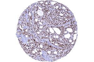 A strong nuclear AR immunostaining is seen in all cells of a prostatic adenocarcinoma Gleason (Recombinant Androgen Receptor 抗体  (AA 1-100))