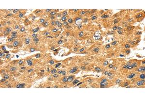 Immunohistochemistry of paraffin-embedded Human liver cancer tissue using SH3KBP1 Polyclonal Antibody at dilution 1:45 (SH3KBP1 抗体)