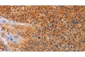 Immunohistochemistry of paraffin-embedded Human liver cancer tissue using ADHFE1 Polyclonal Antibody at dilution 1:30 (ADHFE1 抗体)