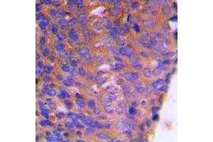Immunohistochemical analysis of CBR1 staining in human breast cancer formalin fixed paraffin embedded tissue section. (CBR1 抗体  (Center))