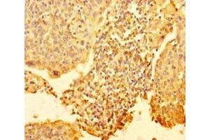 Immunohistochemistry of paraffin-embedded human cervical cancer using ABIN7168303 at dilution of 1:100 (RTF1 抗体  (AA 620-670))