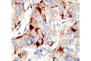 IHC analysis of FFPE human hepatocarcinoma stained with the Dnmt2 antibody (Dnmt2 抗体  (AA 201-230))