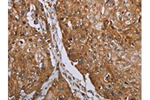 The image on the left is immunohistochemistry of paraffin-embedded Human esophagus cancer tissue using ABIN7192846(TNPO1 Antibody) at dilution 1/25, on the right is treated with synthetic peptide. (Transportin 1 抗体)