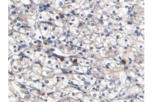 DAB staining on IHC-P; Samples: Human Renal cancer Tissue (S100A8 抗体  (AA 1-93))