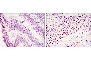 Immunohistochemical analysis of paraffin-embedded colonic cancer tissues (left) and lung cancer tissues (right) using KDM3A mouse mAb with DAB staining. (KDM3A 抗体)