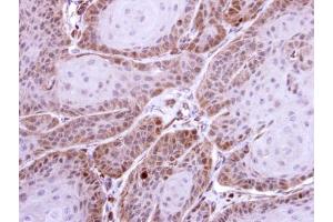 IHC-P Image Immunohistochemical analysis of paraffin-embedded Cal27 xenograft, using HS1BP3, antibody at 1:500 dilution.