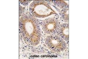 Formalin-fixed and paraffin-embedded human colon carcinoma tissue reacted with FGF1 antibody (N-term) (ABIN390361 and ABIN2840769) , which was peroxidase-conjugated to the secondary antibody, followed by DAB staining. (FGF1 抗体  (N-Term))