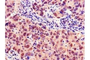 Immunohistochemistry of paraffin-embedded human pancreatic cancer using ABIN7160378 at dilution of 1:100 (MYBL2 抗体  (AA 188-366))
