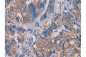 DAB staining on IHC-P; Samples: Human Breast cancer Tissue (IL1R1 抗体  (AA 226-318))